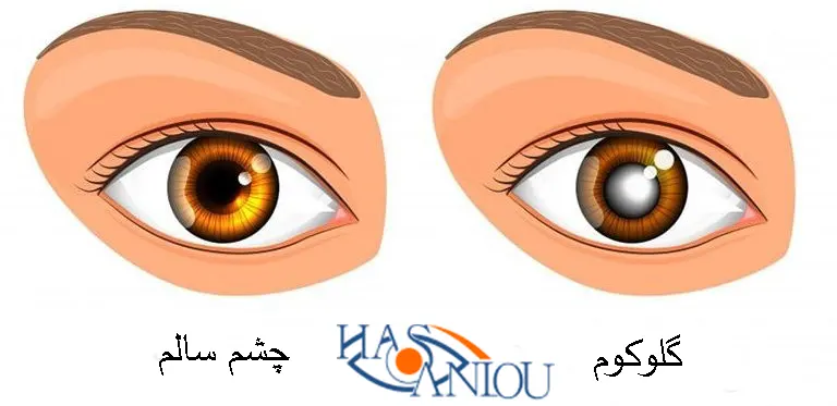 گلوکوم