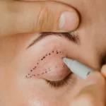 جای بخیه بعد از بلفاروپلاستی - دکتر نرگس حسنلو