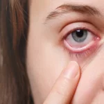 سوزش چشم بعد از عمل لیزیک - دکتر نرگس حسنلو