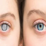 عمل آب سیاه چشم خطرناک است؟ - دکتر نرگس حسنلو