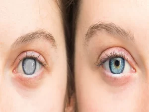 عمل آب سیاه چشم خطرناک است؟ - دکتر نرگس حسنلو