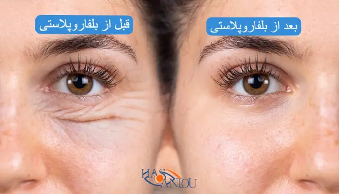 بلفاروپلاستی