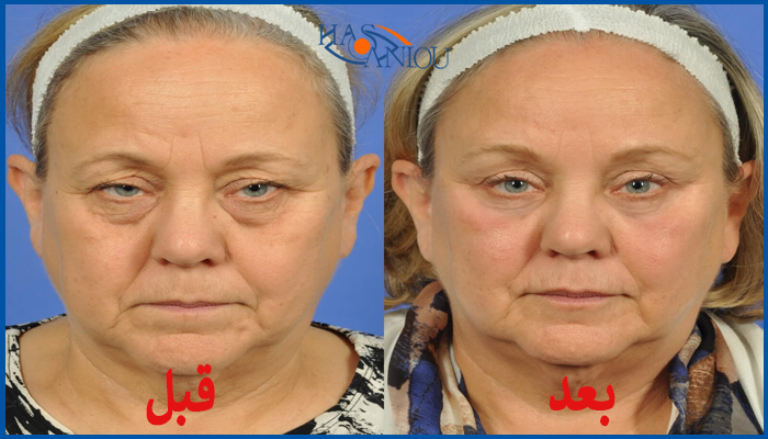 مراقبت های بعد از عمل ترمیم پلک