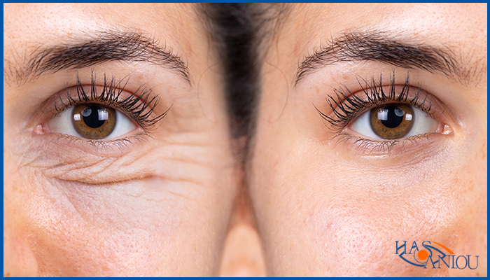 Blepharoplasty