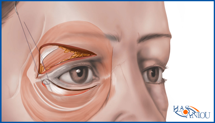 Canthoplasty