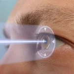 عمل فمتولیزیک بهتر است یا لیزیک؟ - دکتر نرگس حسنلو