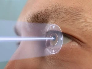عمل فمتولیزیک بهتر است یا لیزیک؟ - دکتر نرگس حسنلو