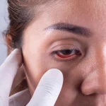 پیشگیری از آب سیاه چشم - دکتر نرگس حسنلو