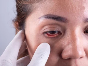 پیشگیری از آب سیاه چشم - دکتر نرگس حسنلو