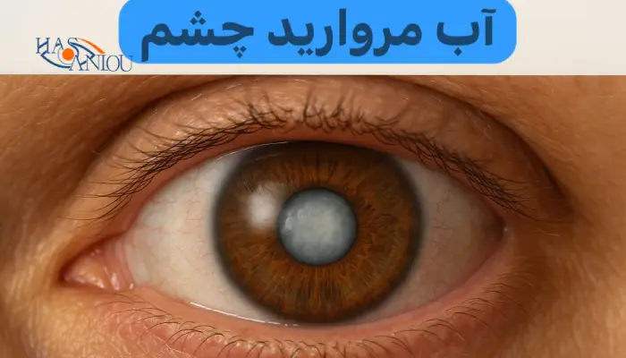 آب مروارید چشم 