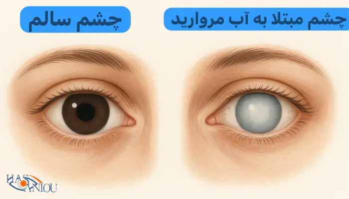 آب مروارید چشم 