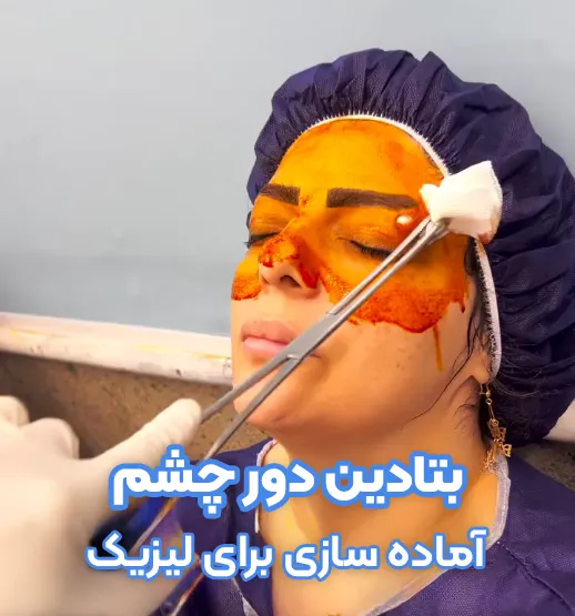 بتادین قبل لیزیک