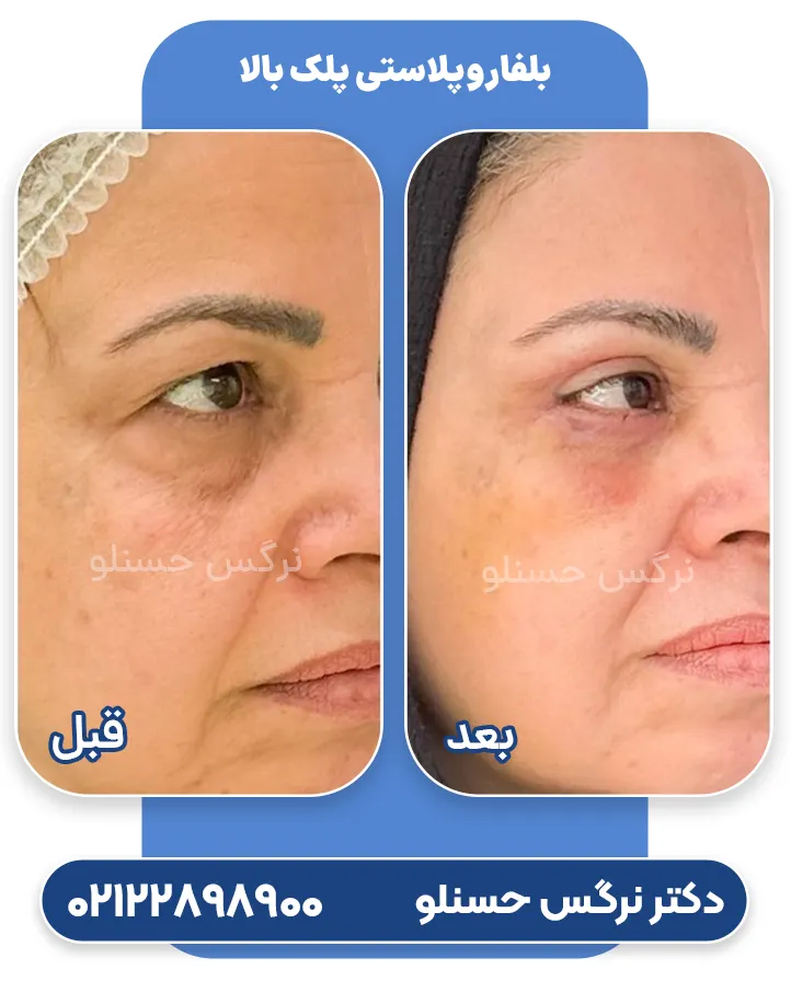قبل و بعد بلفاروپلاستی