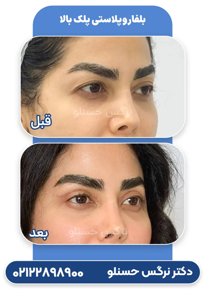 قبل و بعد بلفاروپلاستی