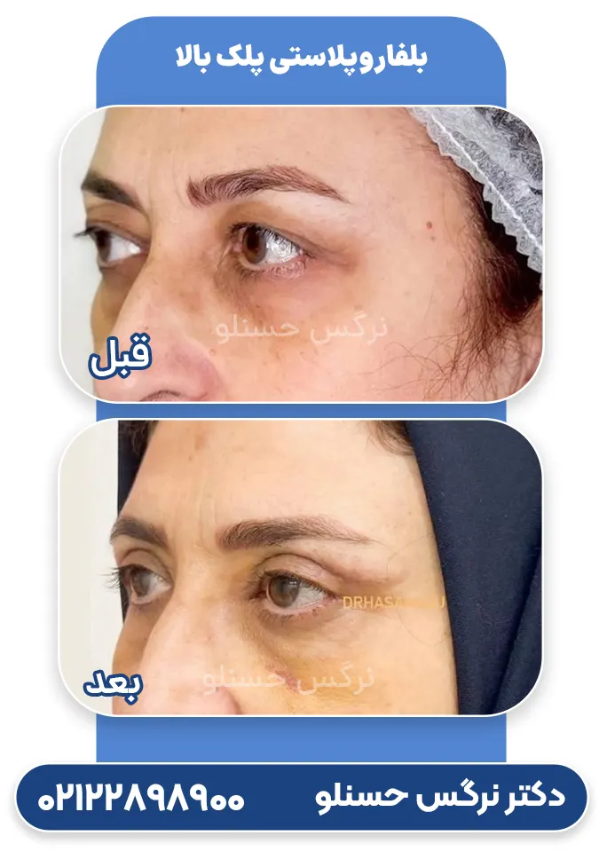 Upper eyelid blepharoplasty-hasanlou-04