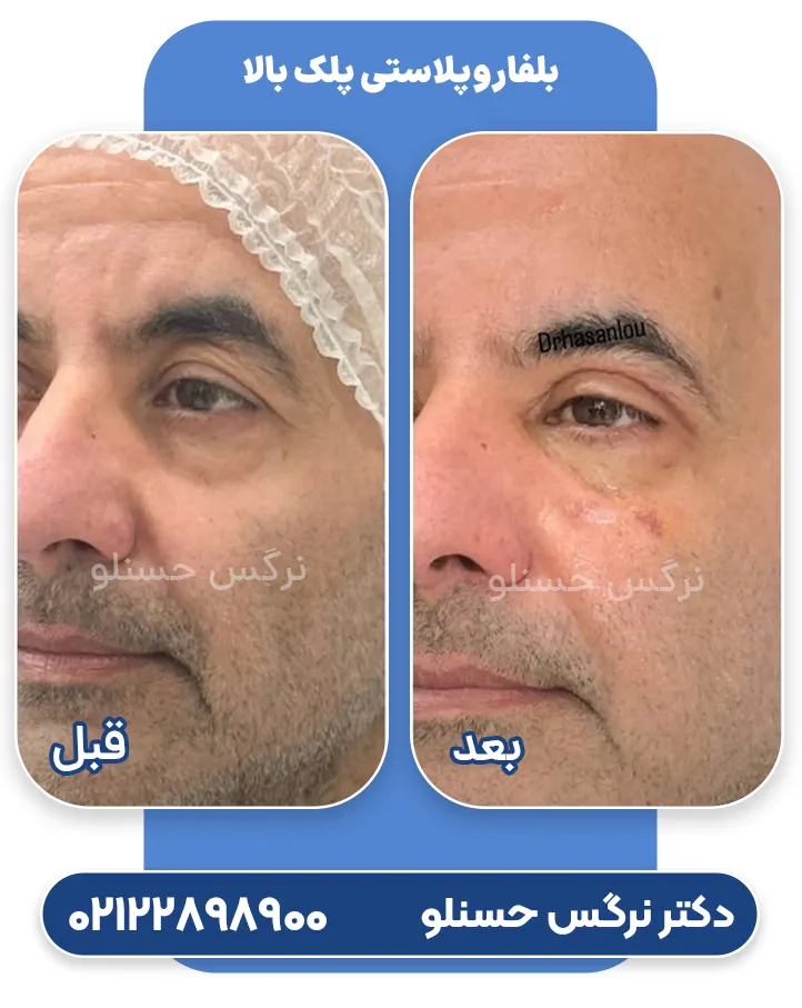 Upper eyelid blepharoplasty-hasanlou-06