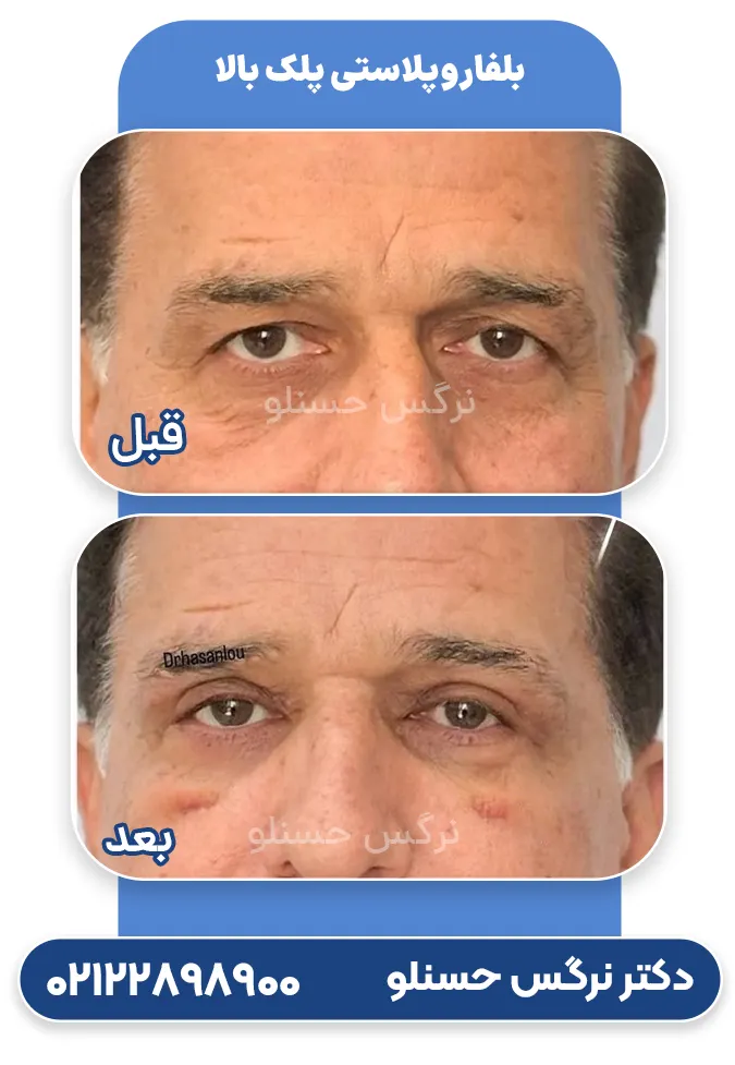 قبل و بعد بلفاروپلاستی