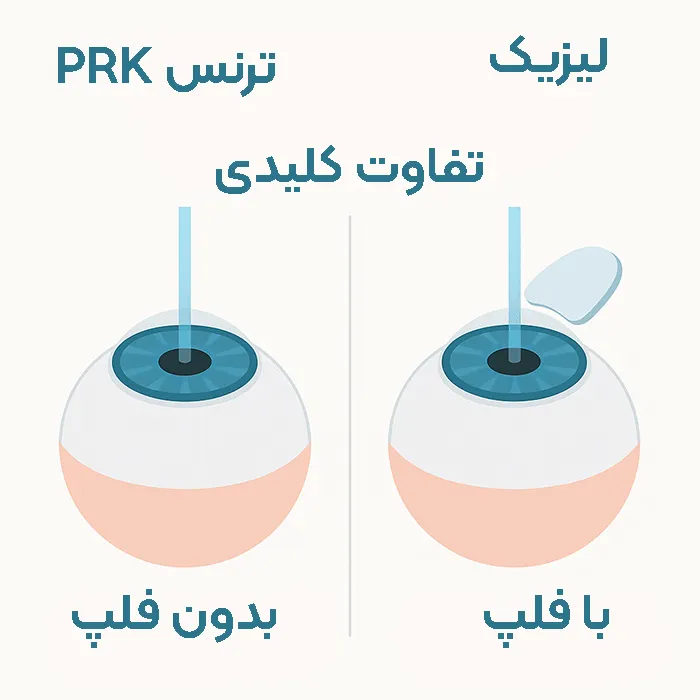تفاوت لیزیک و ترنس PRK