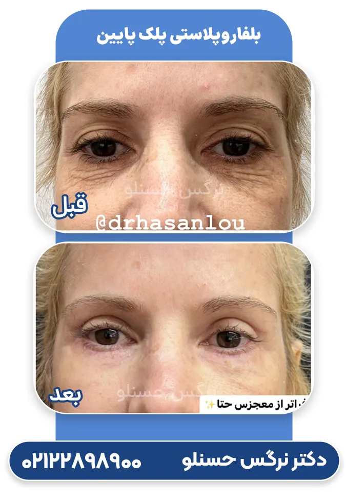 بلفاروپلاستی پلک پایین