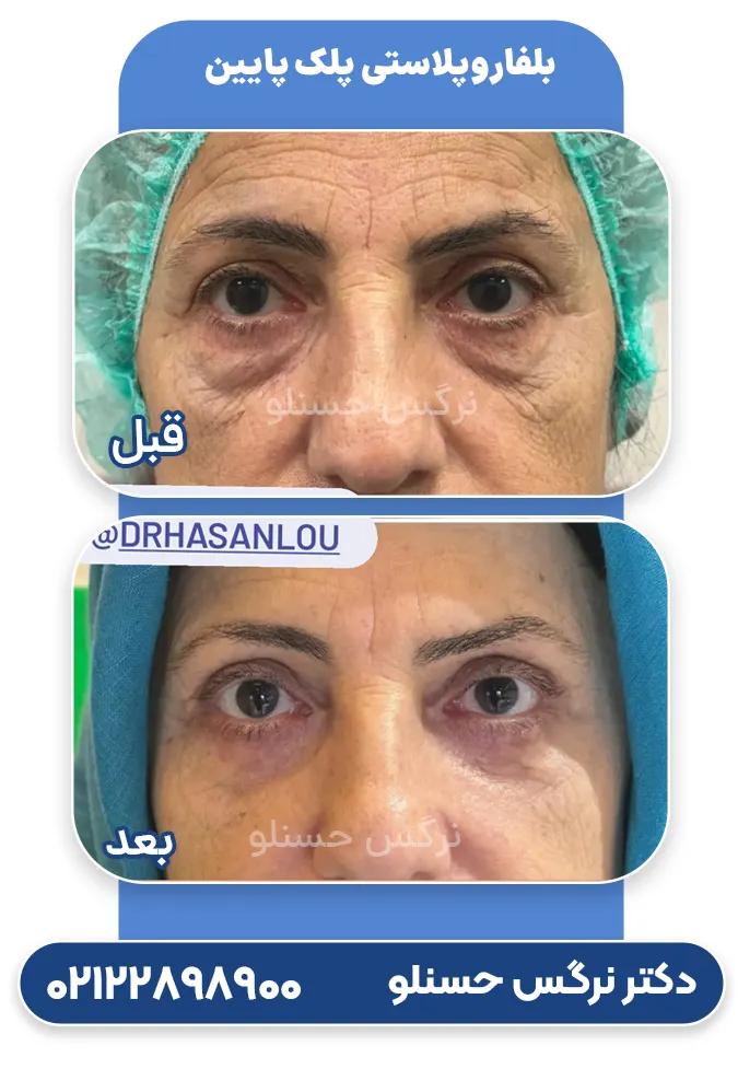 بلفاروپلاستی پلک پایین