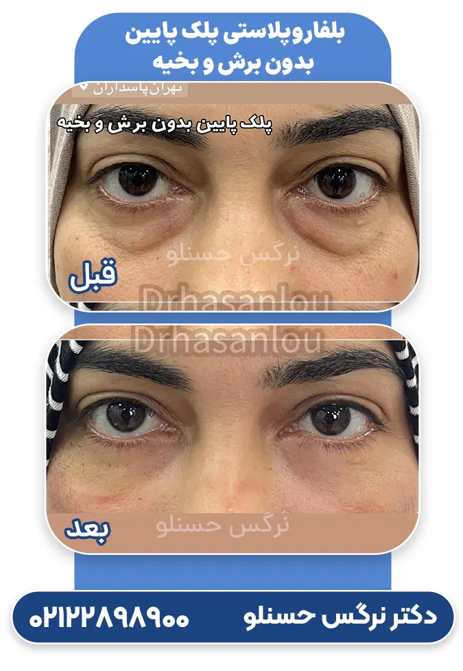 بلفاروپلاستی پلک پایین