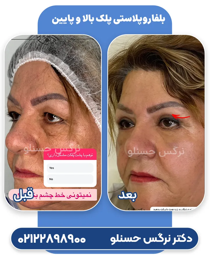 بلفاروپلاستی پلک پایین