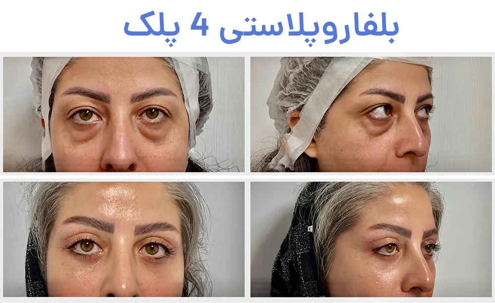بلفاروپلاستی پلک بالا و پایین همزمان