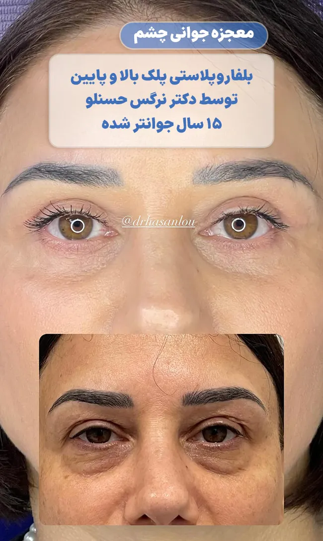 بلفاروپلاستی پلک پایین