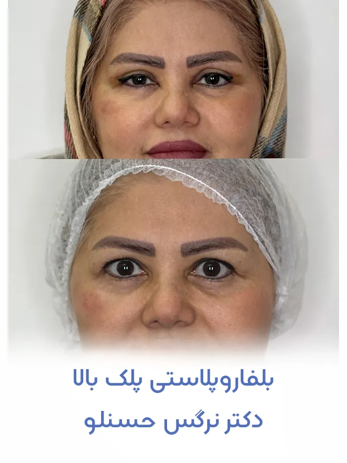 بلفاروپلاستی پلک بالا