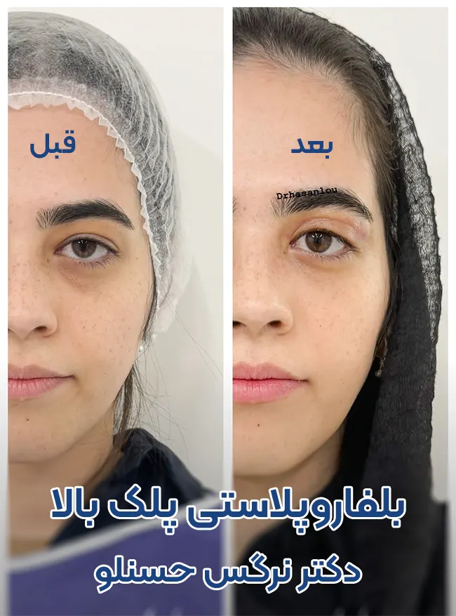 بلفاروپلاستی پلک بالا