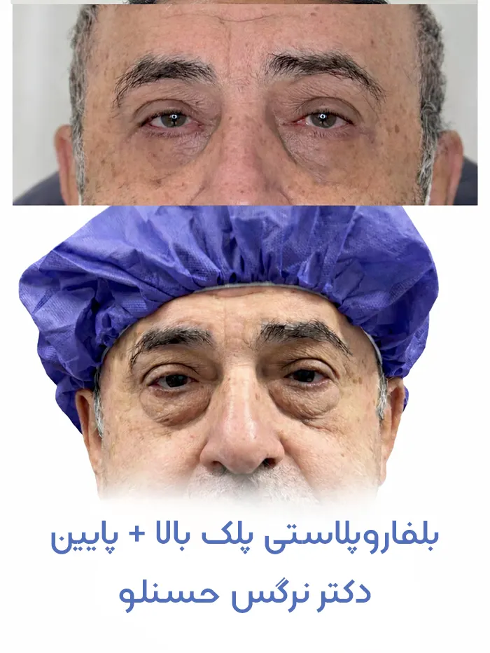 بلفاروپلاستی پلک بالا + پلک پایین