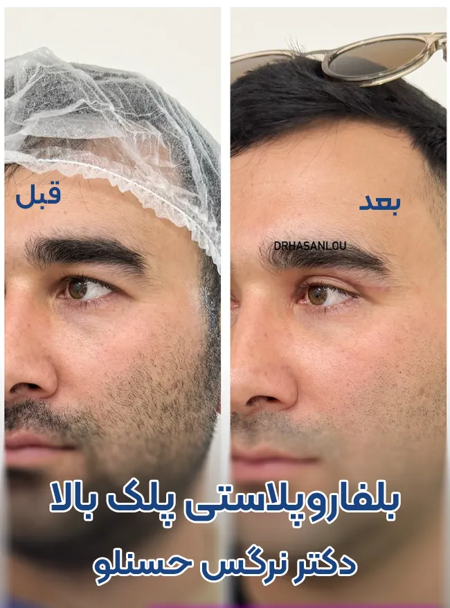 بلفاروپلاستی پلک بالا