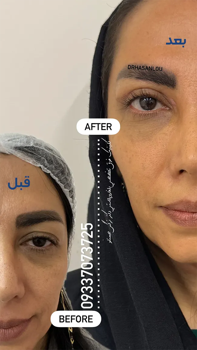 بلفارو با دکتر نرگس حسنلو