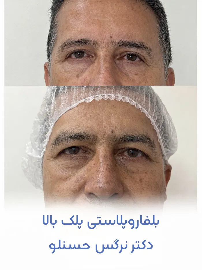 بلفاروپلاستی پلک بالا