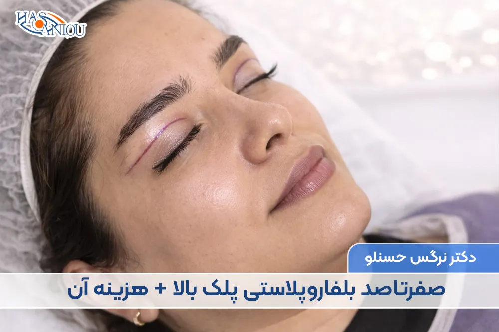 صفرتاصد بلفاروپلاستی پلک بالا