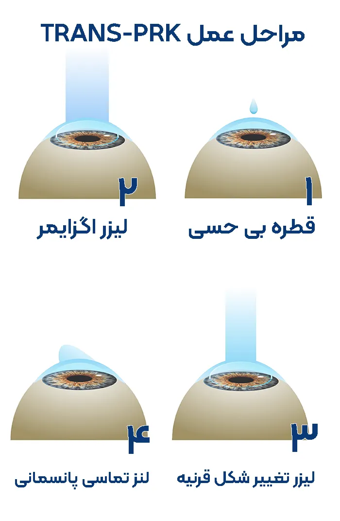 مراحل عمل ترنس PRK