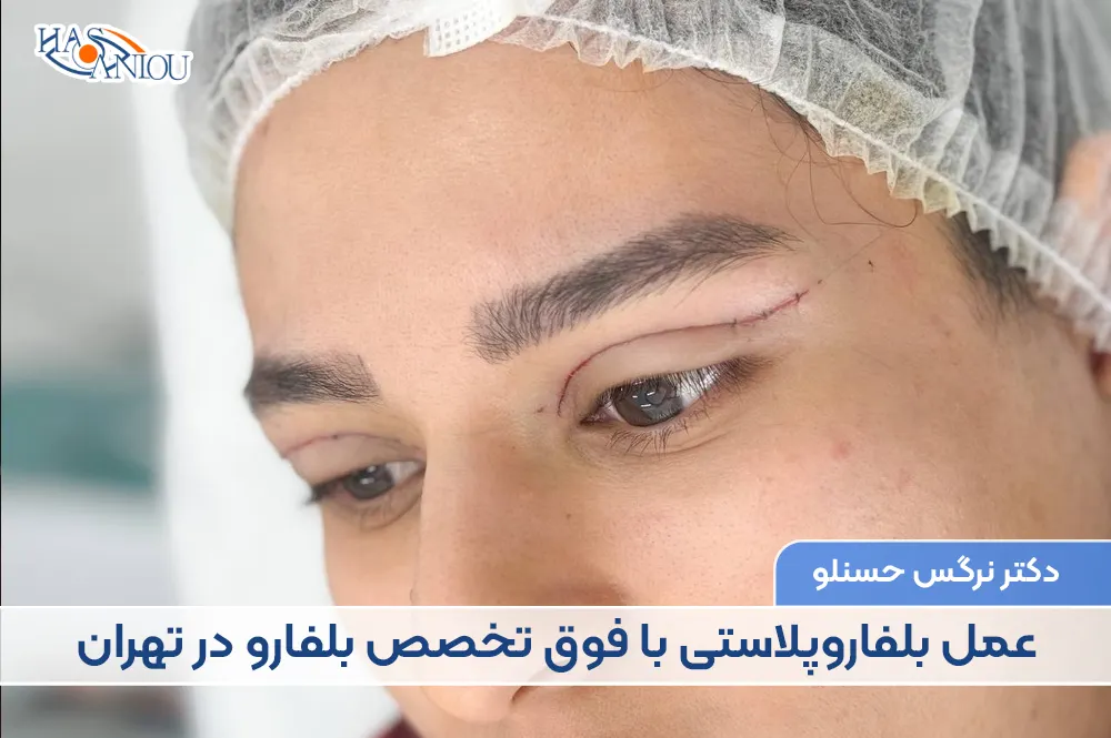 عمل بلفاروپلاستی در تهران
